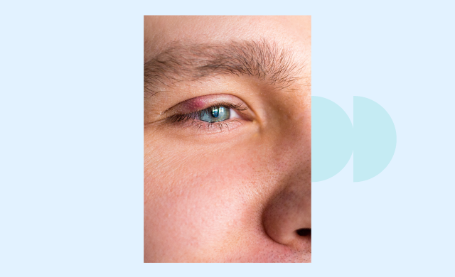 The symptoms of stye